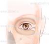 Изменение разреза глаз (кантопексия)